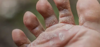 무좀 증상&amp;#44; 치료&amp;#44; 재발방지 총 정리 (2025 최신)