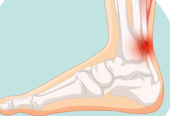 류마티스 관절염 결론