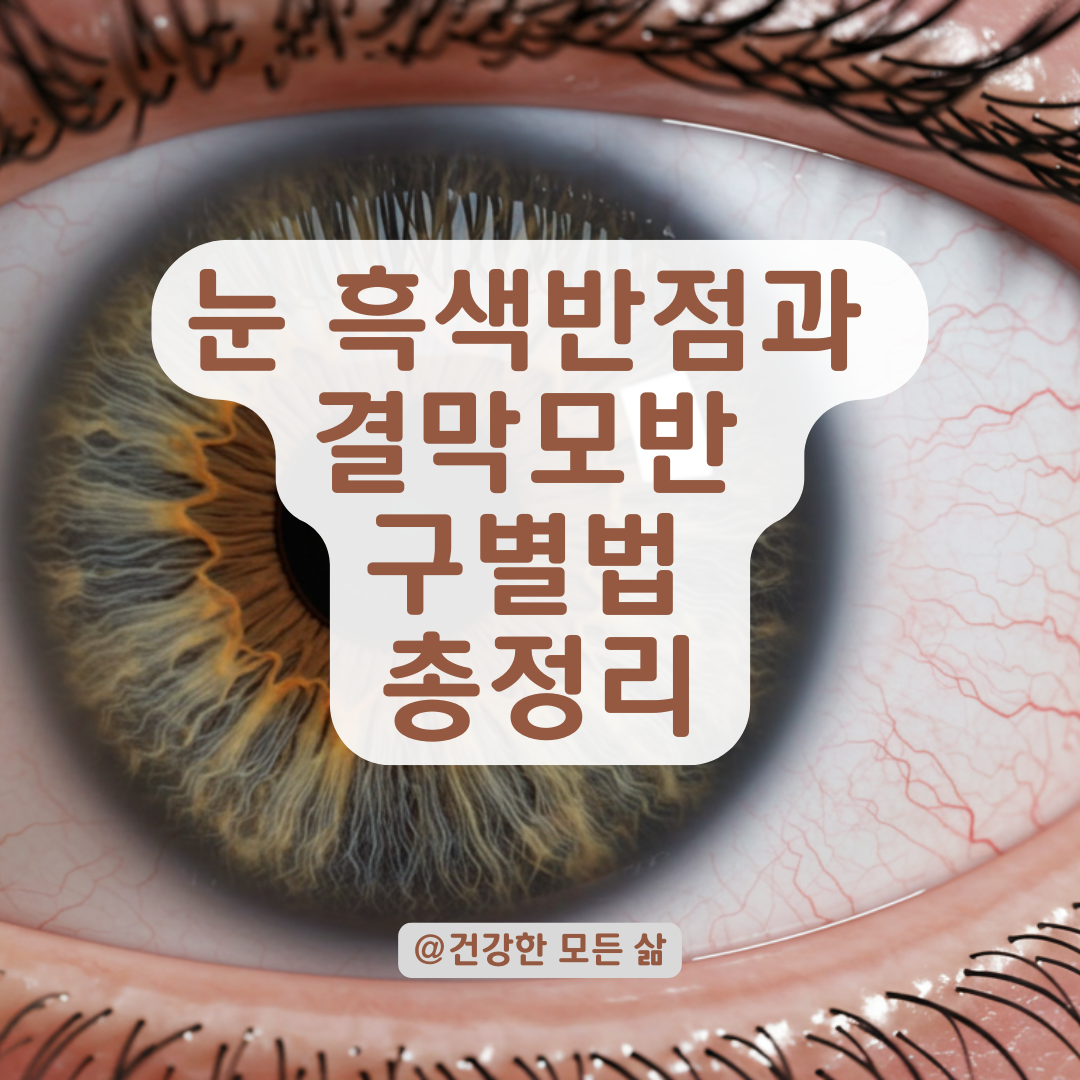 결막모반인지 걱정된다면? 눈 흑색반점과 실핏줄 증상별 확인법 총정리.