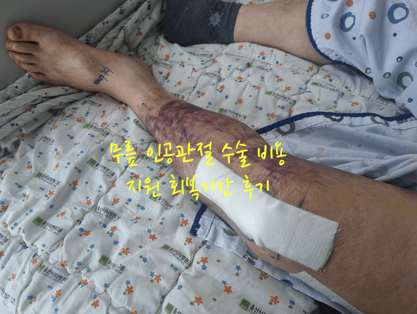 무릎 인공관절 수술 비용