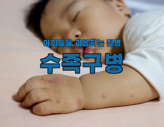 수족구병 완벽 가이드: 증상부터 예방까지