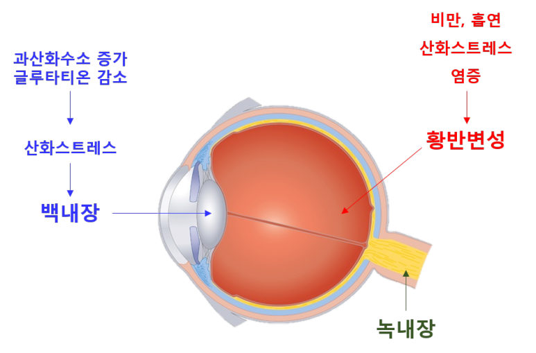 녹내장