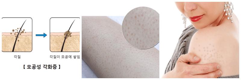 모공각화증 사진 3개