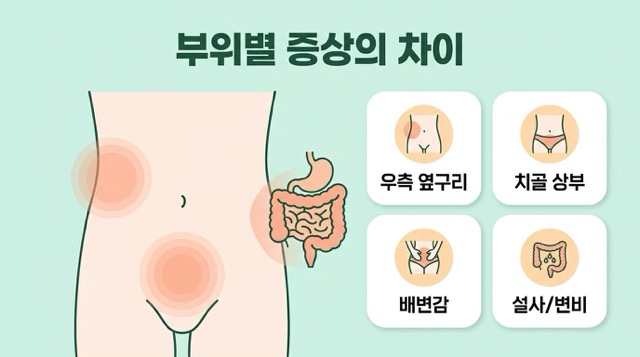 충수 위치에 따라 달라지는 맹장염 증상 우측 옆구리 치골 위 불편감