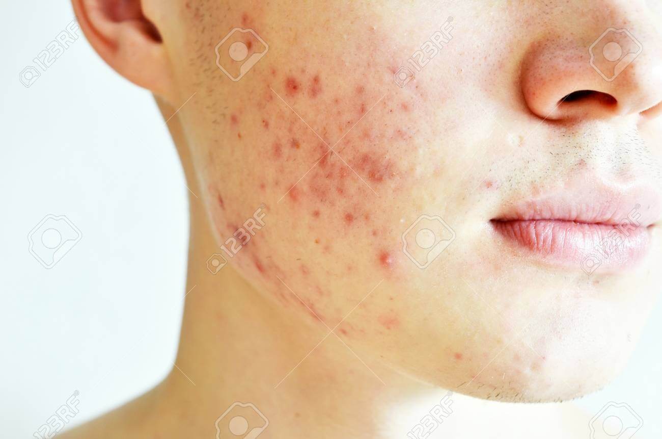 남자 여드름 관리 방법과 단기간 개선 팁을 설명하는 피부 관리 정보 이미지로 남성 피부 특성에 맞는 세안법과 면도 후 케어 방법을 담은 스킨케어 가이드 자료