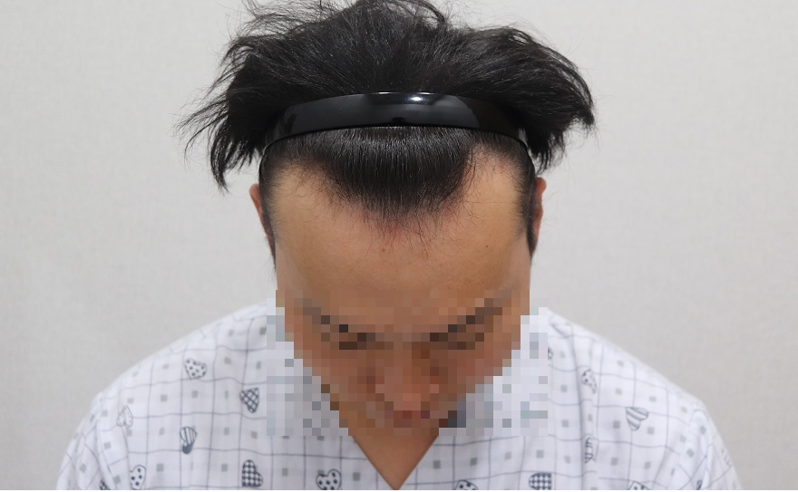 모발이식 수술전