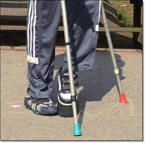 구획증후군 원인 및 증상