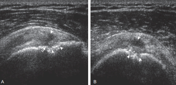 supraspinatus : partial -thickness tear