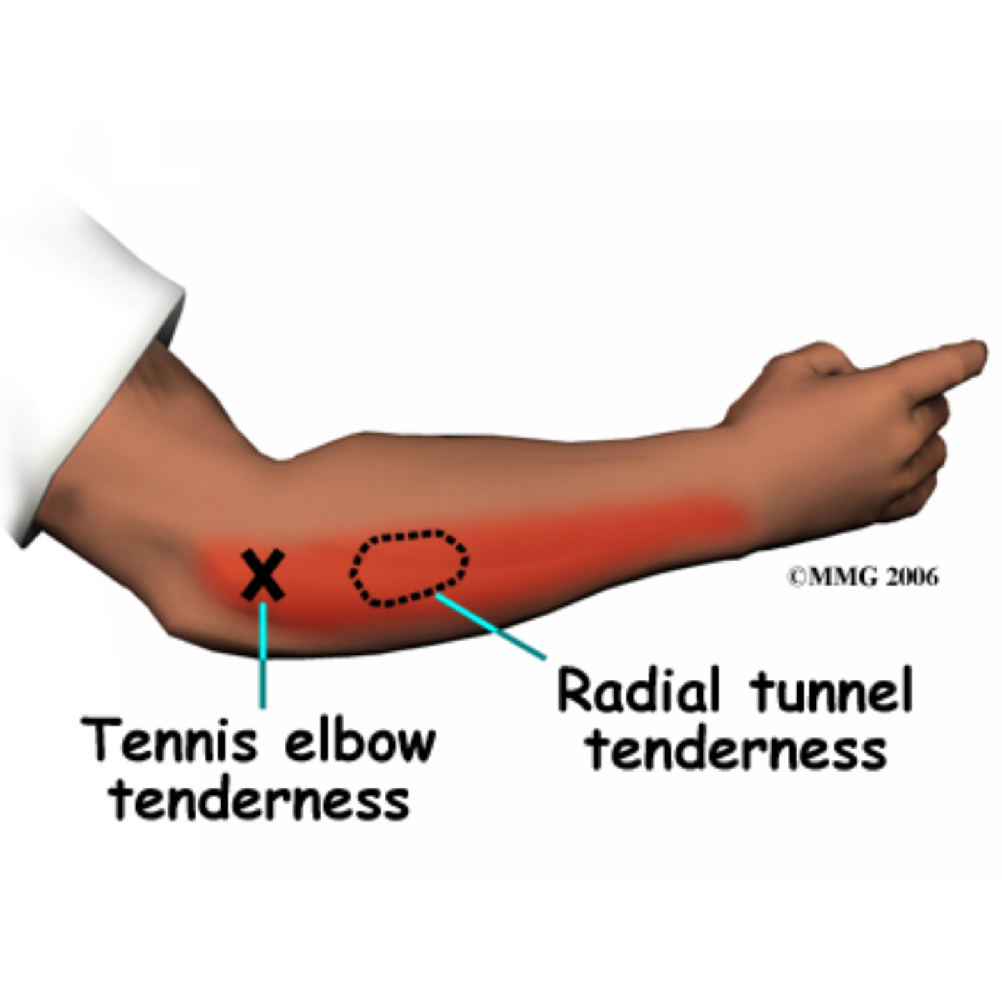 염증이 생기는 부위 그림 사진 : AI 생성기