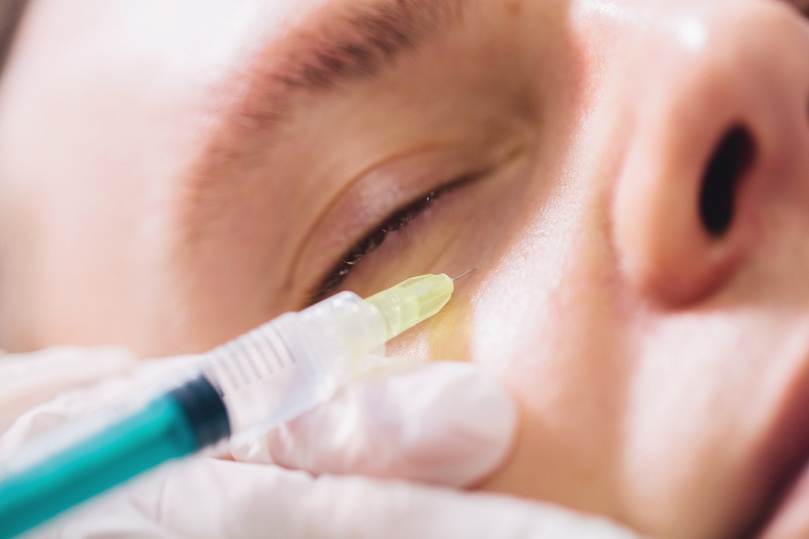 스컬트라(Sculptra): 콜라겐 생성 촉진 주사