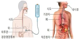위루관 수술이란 위루술PEG 방법 적응증 부작용 총정리 병원선택_52