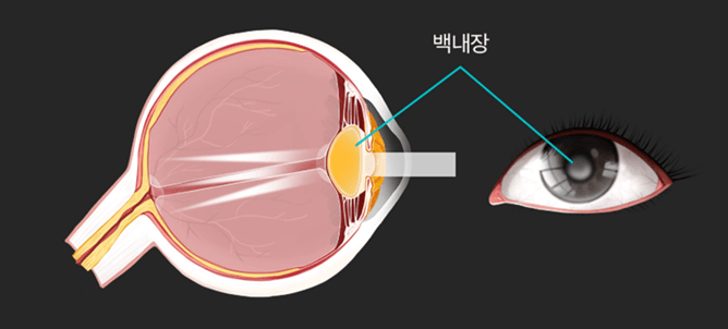 백내장 초기 증상