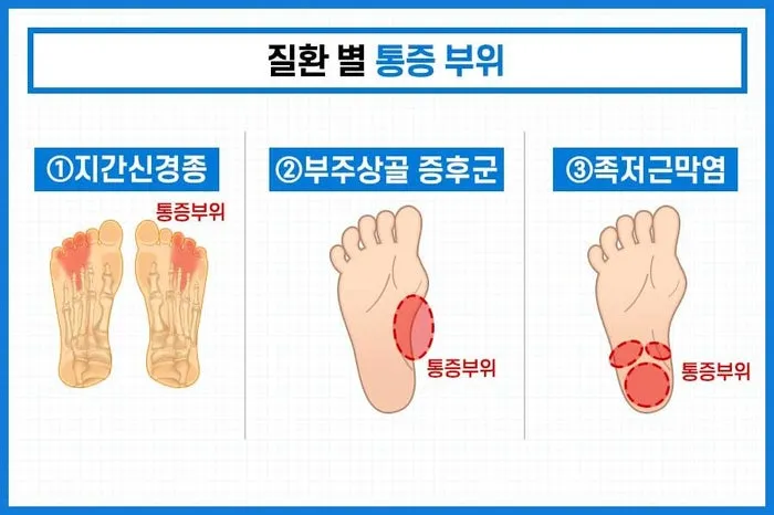 발바닥통증의 원인들과 해결책_2
