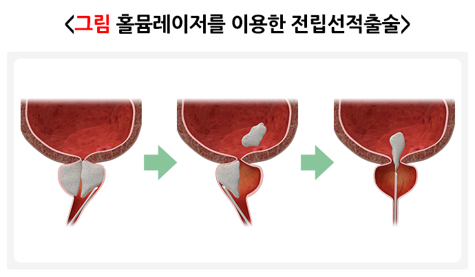 홀뮴레이저를-이용한-전립선적출술을-표현한-그림