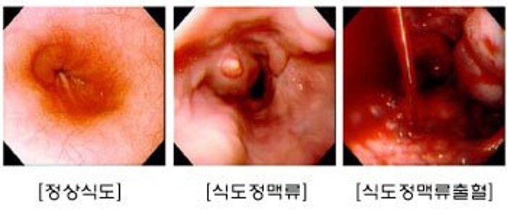 식도정맥류