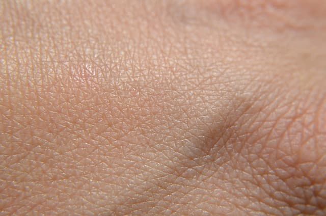 아토피피부염의 감염