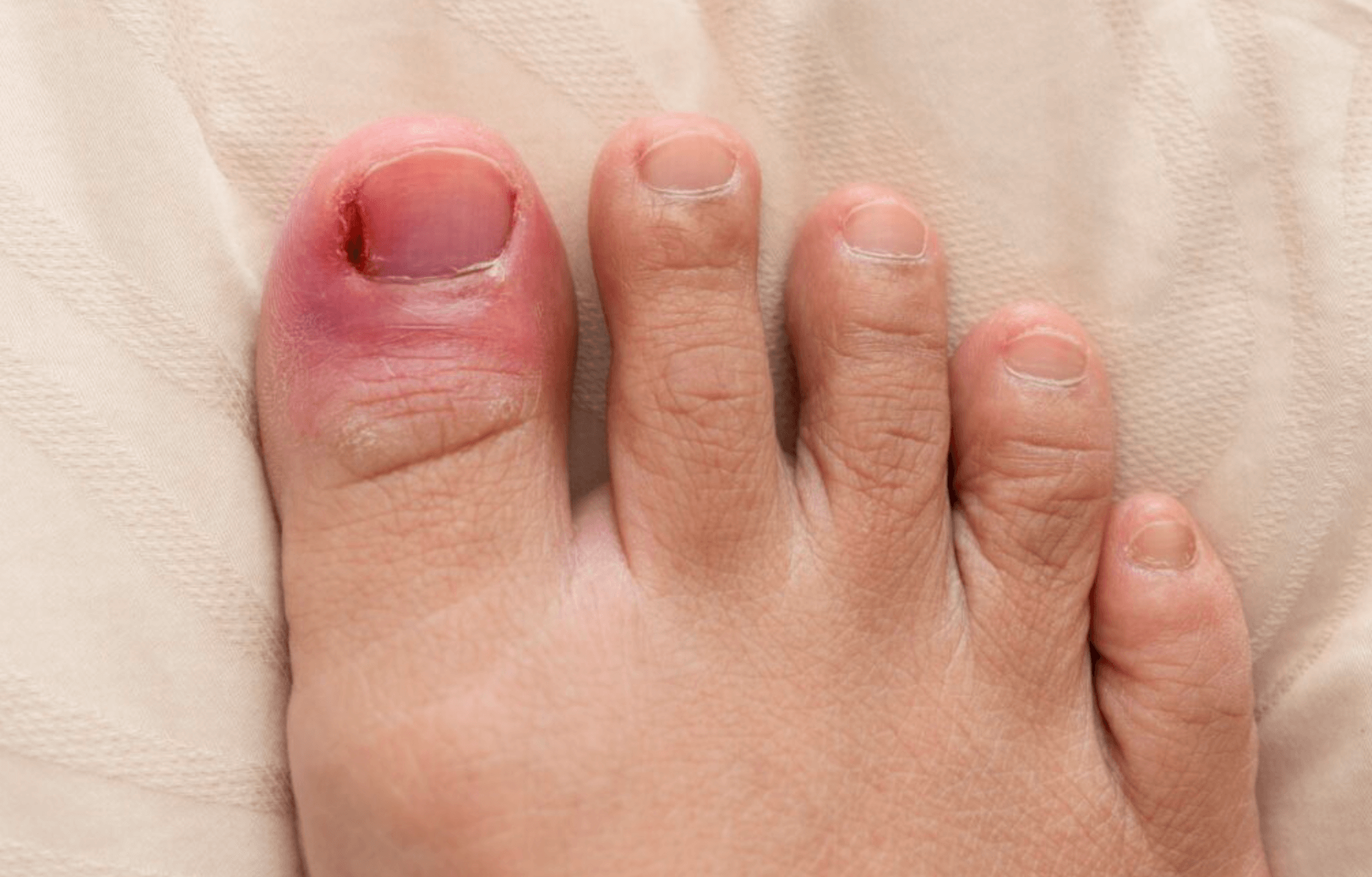 발가락 내성발톱