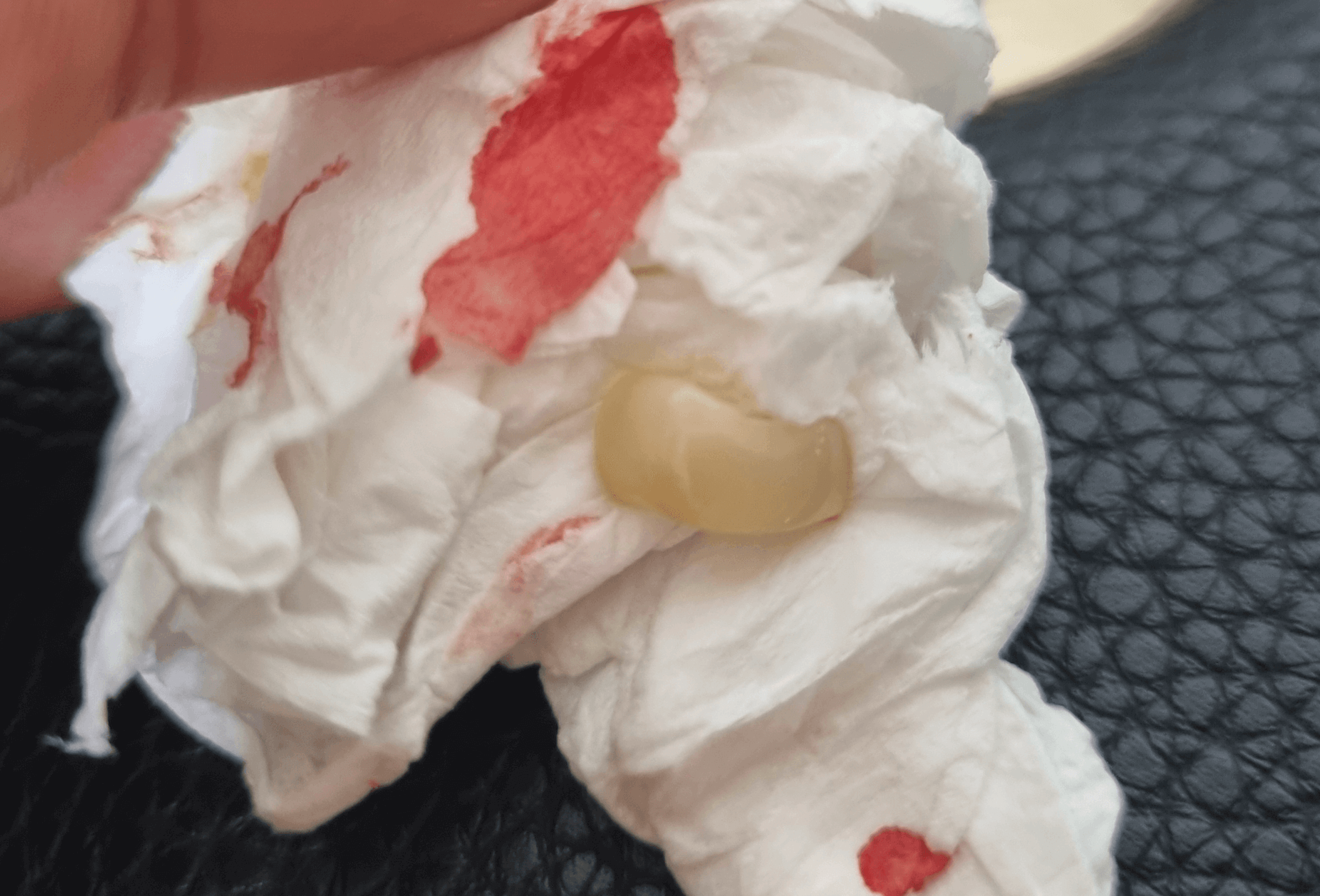 지르코니아 후기