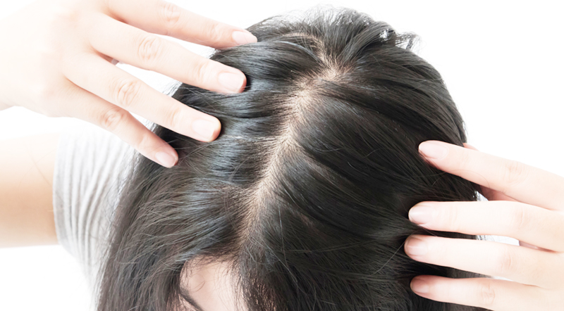 탈모 치료 예방