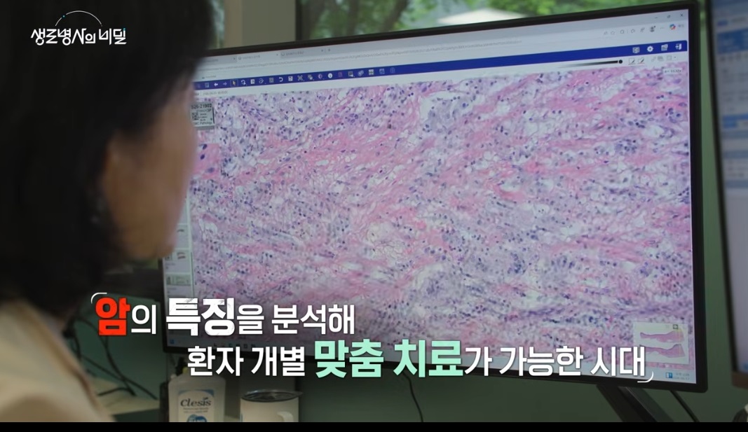 생로병사의비밀-위암보고서-권민석교수