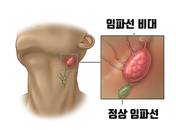 임파선염에 걸리는 이유