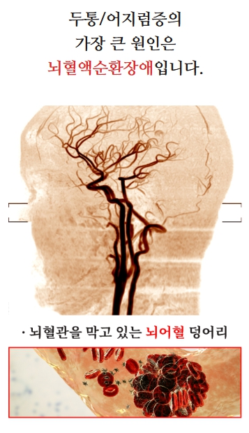 두통, 어지럼증의 원인은 뇌 어혈로 인한 뇌 혈액순환장애입니다