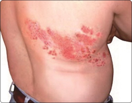 대상포진 예방접종 가격