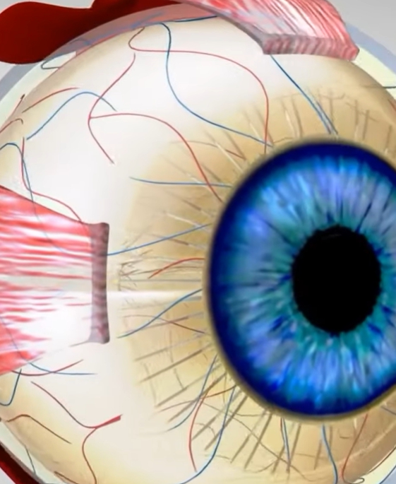 녹내장 초기증상
