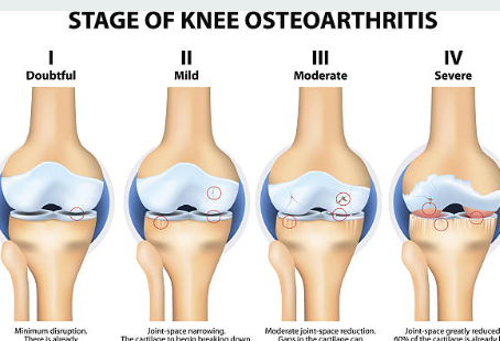 류마티스 관절염