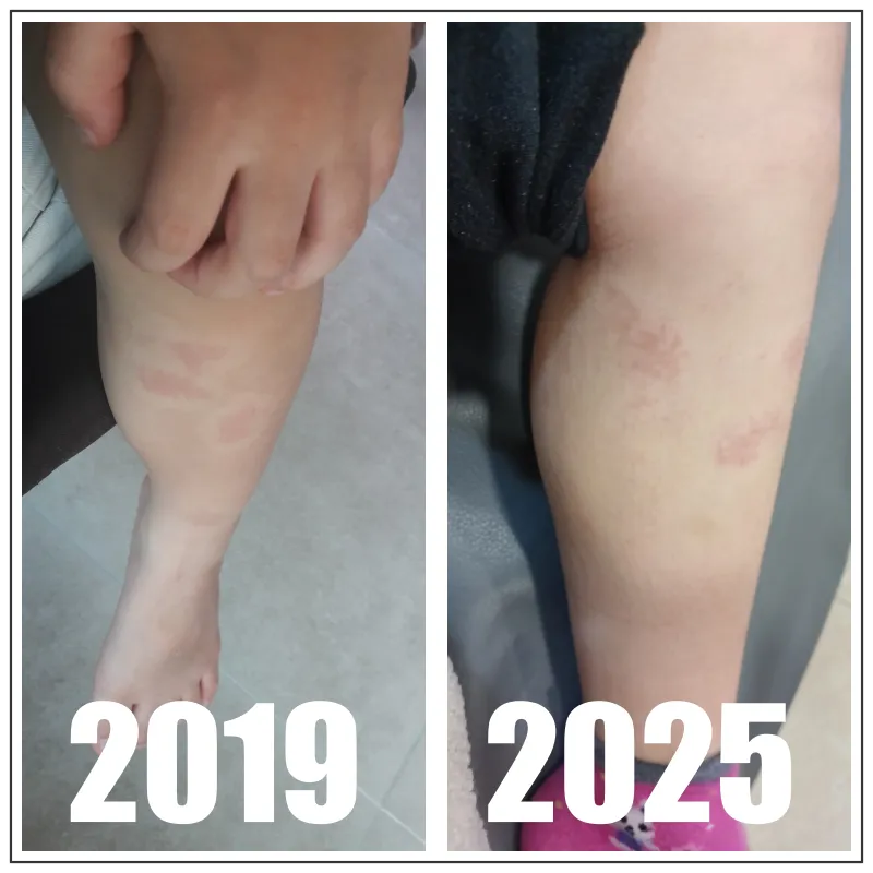 왼쪽과-오른쪽으로-나위어져-있음-왼쪽은-2019년-이라고-써있고-아이다리보임-다리종아리쪽에-빨간점-보임-오른쪽에-2025년이라고-써있고-아이다리보임-빨간점이-약간-흐려짐