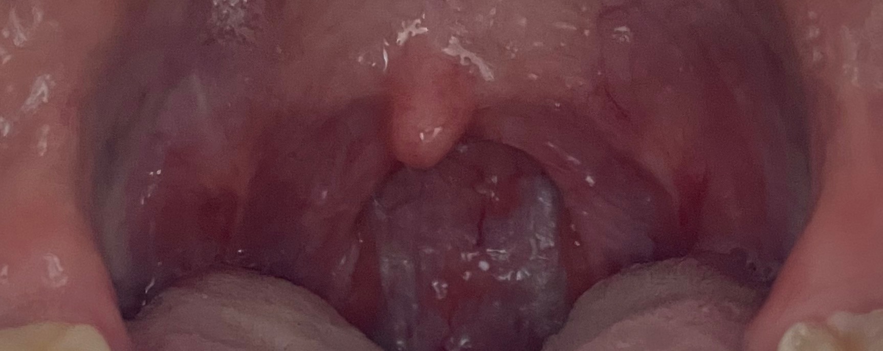 편도 절제 수술 한 달 후