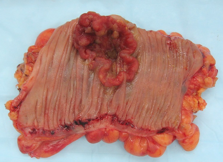 [C00-D48] Ⅱ. 신생물(C00-D48)