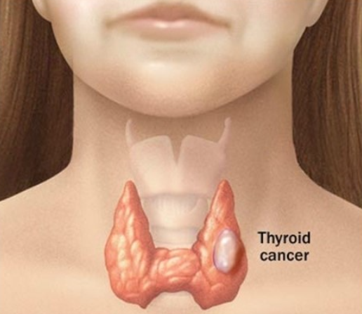 갑상선기능항진증의 원인