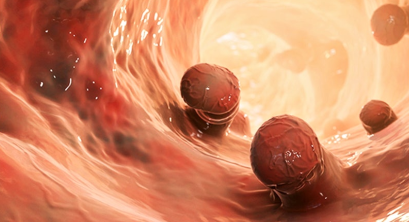 용종제거-사진2