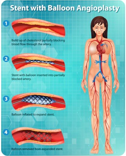혈관에 끼어 있는 찌꺼기들
