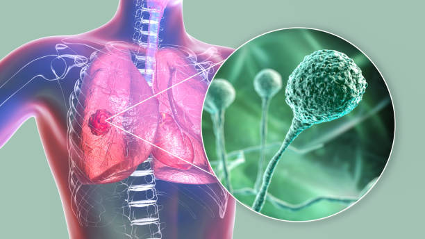 과탄산혈증(hypercapnia) 증상