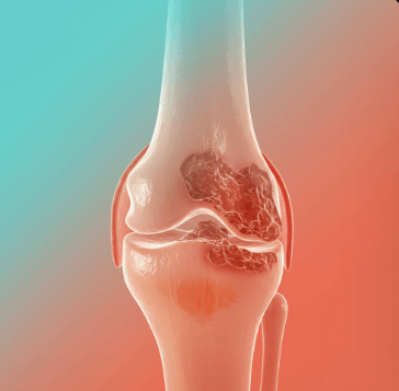 슬개골 연골연화증 증상 및 치료 방법 1