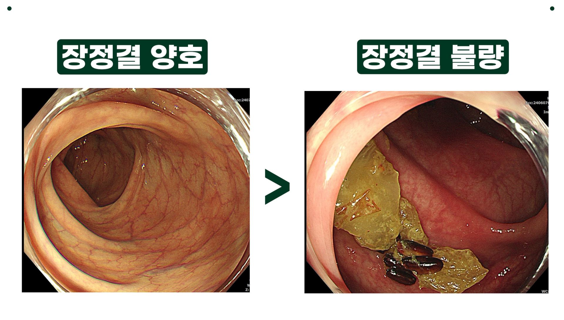 수면대장내시경