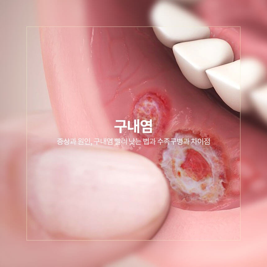 “구내염-증상과-원인-구내염-빨리-낫는-법”