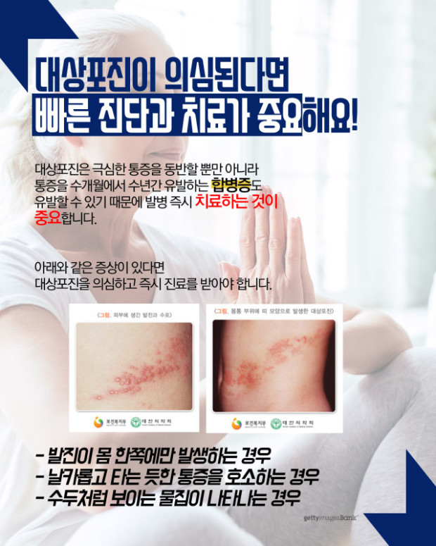 대상포진 증상