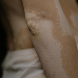 백반증 - 자가면역 질환