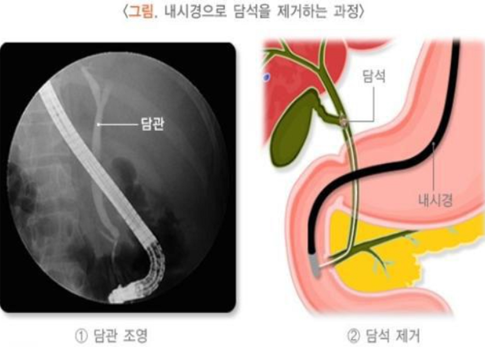 EBS-명의-담석제거