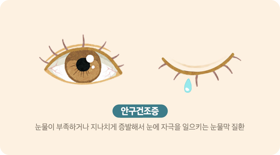 안구-건조증-증상