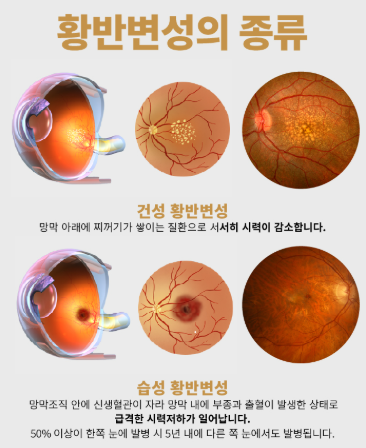 "안경값 아끼세요!" 2026년 어르신 안경 보조금 신청 방법과 자격