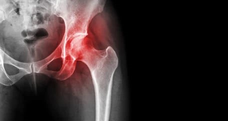 골반괴사의 치료 방법