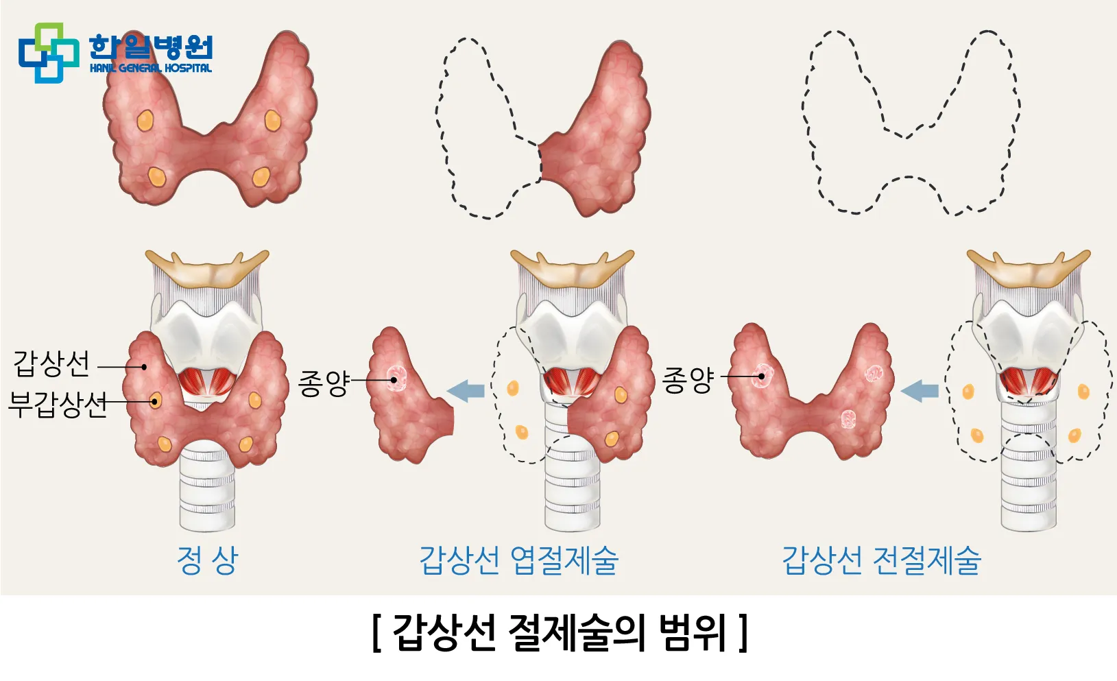 부갑상선기능항진증 수술 후기 2주차 내분비외과 내원 경험담_2