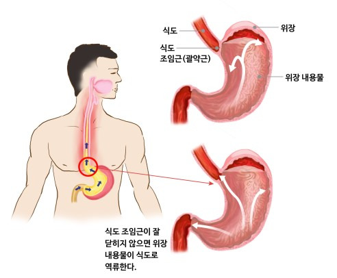 역류성식도염 증상·원인·치료까지