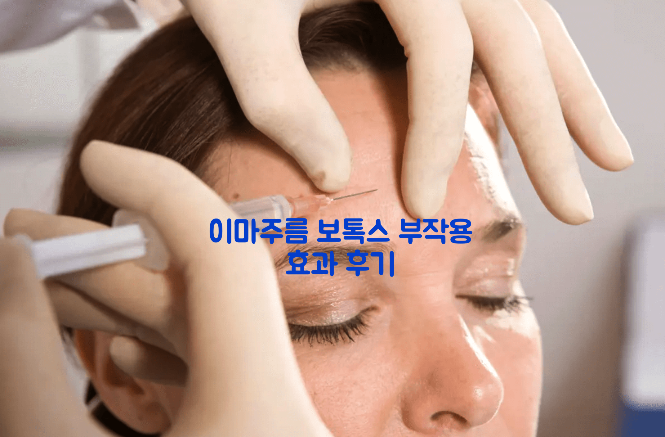이마 보톡스 부작용