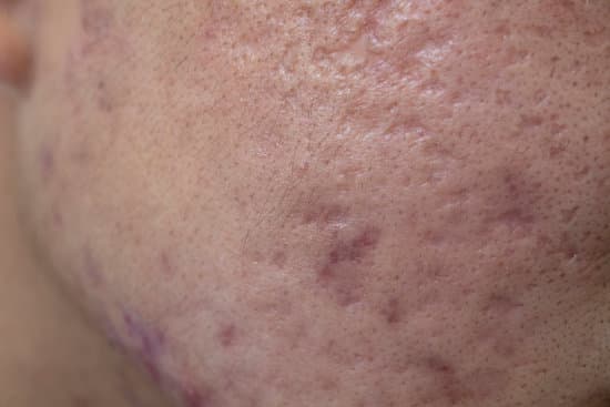 오목한 흉터 (Atrophic Scars): 원인과 효과적인 치료 방법