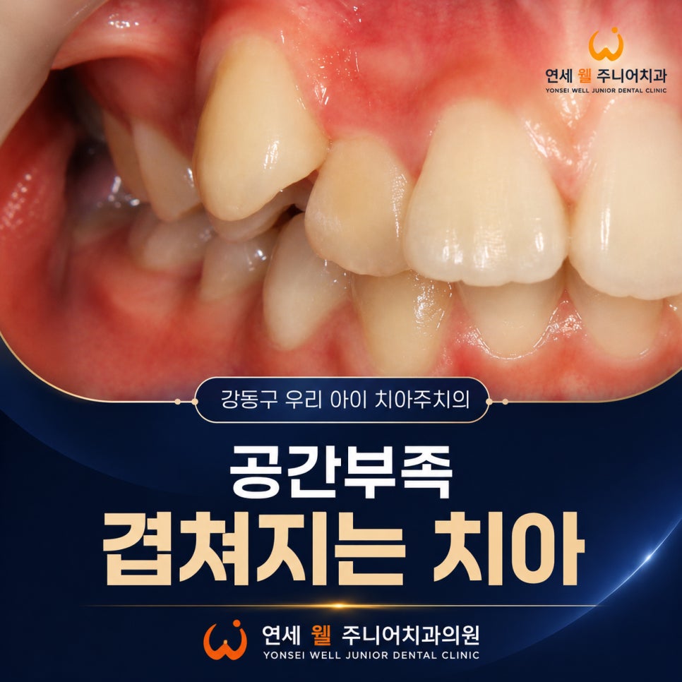 영구치 맹출 공간 부족으로 치아가 겹쳐진 초등학생 덧니 모습